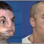 The Most Extensive Face Transplant in History